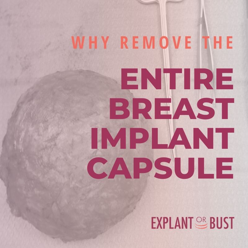 Removing The Entire Breast Implant Capsule – Explant Or Bust!